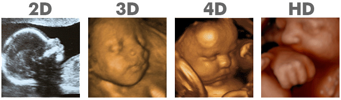 showing the difference between all of the types of ultrasound for babies inside the womb